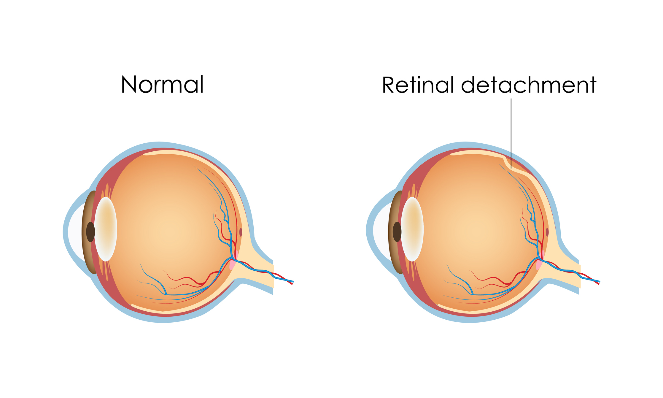 Retinal Detachment Canadian Association Of Optometrists retinal-detachment-canadian-association-of-optometrists